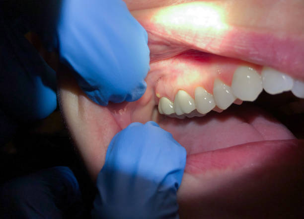 Best Same-Day Emergency Dental Services in Lochsloy, WA